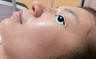 ジェネシスレーザーで毛穴をきれいに！！！の症例写真[アフター]