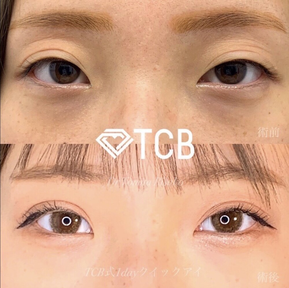 Tcb式1dayクイックアイ 二重埋没法の症例写真 画像 Tcb東京中央美容外科 渋谷西口院 Cs50964 美容医療の口コミ広場