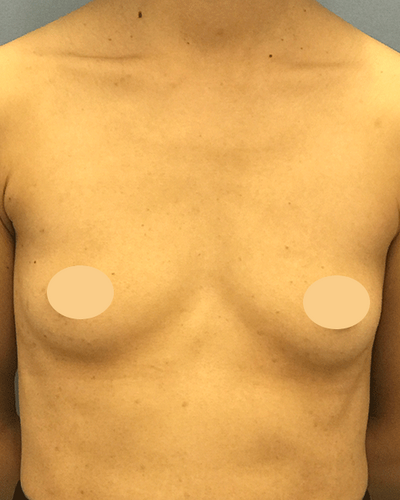 クイック豊胸 300cc ヒアルロン酸注入 豊胸 の症例写真 画像 湘南美容クリニック 高崎院 Cs 美容医療の口コミ広場