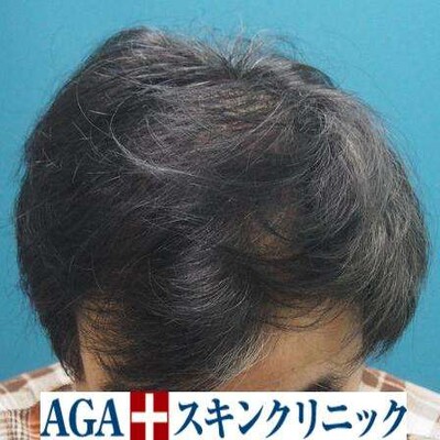Rebirth+Dr’sメソ｜50代｜8ヶ月の症例写真[アフター]