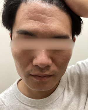ニキビ跡の治療(ダーマペンエクソソーム、ACRS)の症例写真[ビフォー]