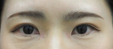 他院目頭切開術後修正の症例写真