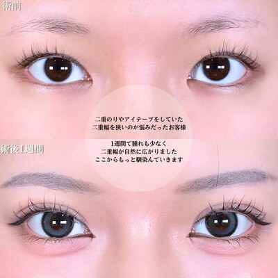 アリエルクイックループトリプル二重埋没法の症例写真