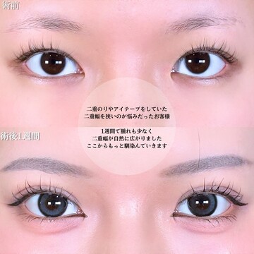アリエル美容クリニック 大宮院の二重の症例写真