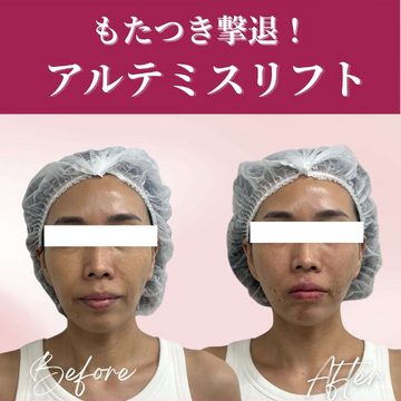 ギャラリークリニックのしわ・たるみ整形(注入、糸、フェイスリフト)の症例写真