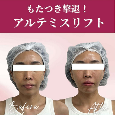アルテミスリフト ショートの症例写真