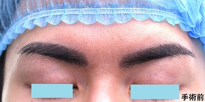 20代　男性　上まぶたの脂肪取り　（埋没法は行なわず）の症例写真[ビフォー]