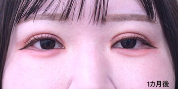 医療法人秀晄会 心斎橋コムロ美容外科クリニックの症例写真[アフター]
