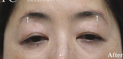 ブロウリフト(眉毛挙上手術)の症例写真[アフター]
