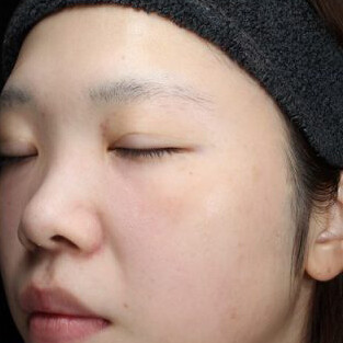 しみ そばかすシミ治療半年プラン途中経過 ２０代女性 フォトフェイシャル ジェネシス ライムライト Qスイッチレーザー シミのレーザー治療 美白治療 そばかす治療 毛穴の引き締めの症例写真 画像 肌と歯のクリニック 東京ベイ幕張 Cs 美容医療