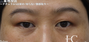 静岡美容外科橋本クリニックの二重の症例写真[ビフォー]