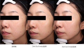 とりい皮膚科クリニックのシミ・肝斑の症例写真