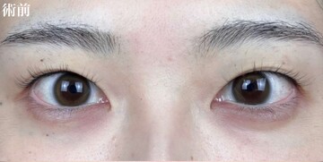 AI Beauty Clinicの二重の症例写真[ビフォー]