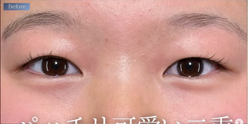 PRISM Beauty Clinicの目・二重整形の症例写真[ビフォー]