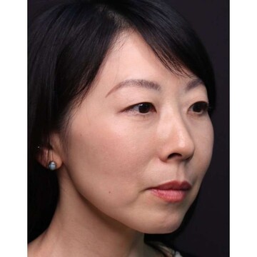 聖心美容クリニックの症例写真[アフター]