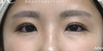 静岡美容外科橋本クリニックの症例写真[アフター]