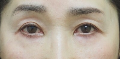 下まぶたのたるみ⼿術（表ハムラ法）の症例写真[アフター]