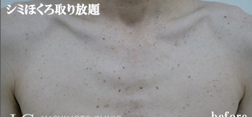 静岡美容外科橋本クリニックのシミ取り・肝斑・毛穴治療の症例写真[ビフォー]
