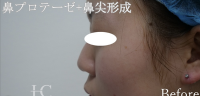 鼻プロテーゼ＋鼻尖形成の症例写真[ビフォー]