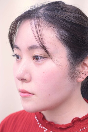 医療法人秀晄会 心斎橋コムロ美容外科クリニックの症例写真[アフター]