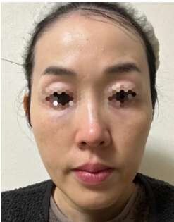 ペルラクリニック神宮前のリフトアップの症例写真[ビフォー]