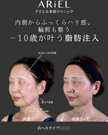 アリエル美容クリニック 郡山院のしわ・たるみ整形(注入、糸、フェイスリフト)の症例写真