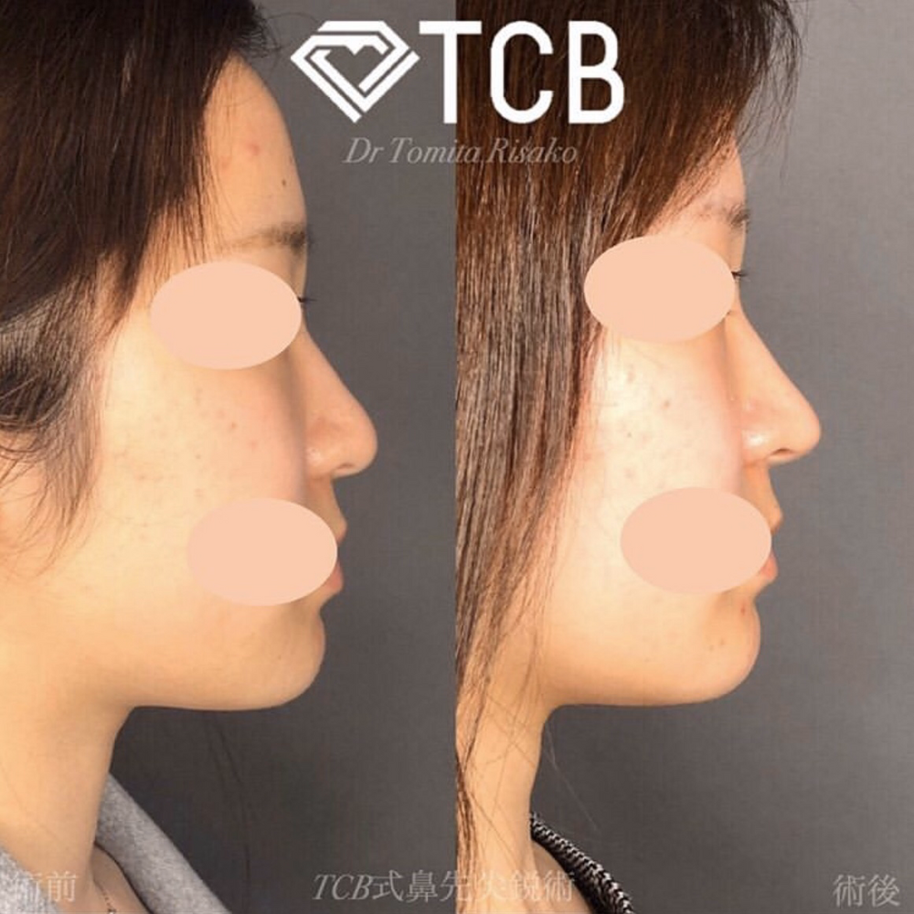 ツンとした鼻先で横顔美人 その他 鼻の整形 の症例写真 画像 Tcb東京中央美容外科 渋谷西口院 Cs 美容医療の口コミ広場