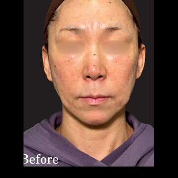 PRISM Beauty Clinicのリフトアップの症例写真[ビフォー]