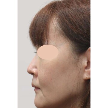 聖心美容クリニックのリフトアップの症例写真[ビフォー]