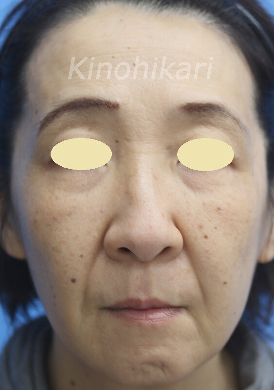 スレッドリフト 4本 術前 直後 3週間後 フェイスリフト手術の症例写真 画像 樹のひかり 形成外科 皮ふ科 Cs506 美容医療の口コミ広場