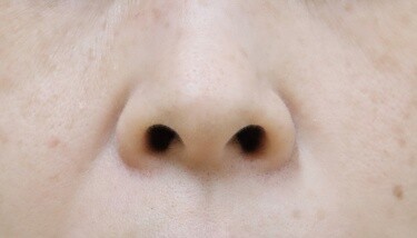 小鼻縮小ボトックスの症例写真[アフター]