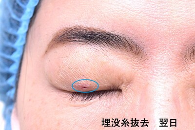 50代　女性　埋没糸抜去　感染を伴わない場合の症例写真