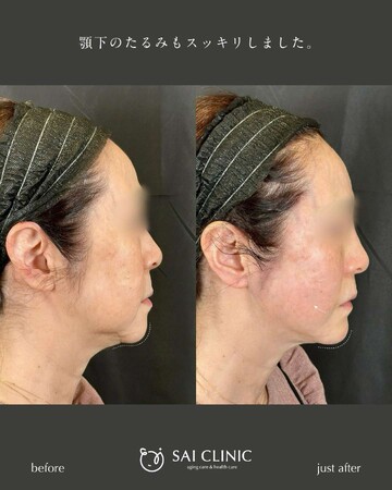 SAI CLINIC （サイクリニック）のリフトアップの症例写真