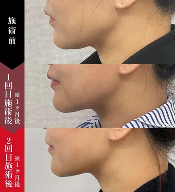 椿クリニックの輪郭・顎・エラ・額・小顔整形の症例写真