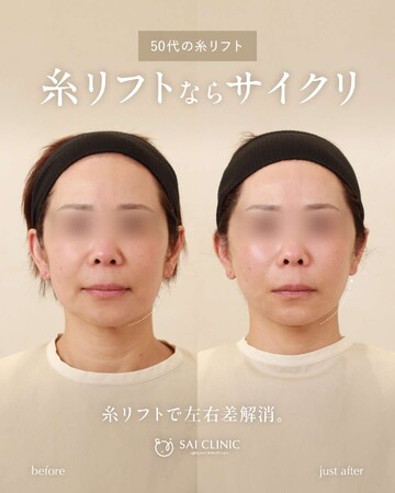 SAI CLINIC （サイクリニック）のリフトアップの症例写真