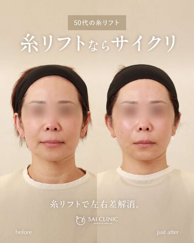 糸リフト（SAI LIFT STANDARD）15本の症例写真