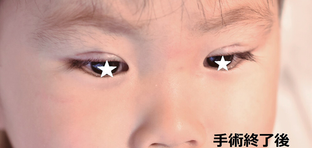 埋没法による幼児逆さまつ毛修正 2歳 男性 ４ｍｍ幅 目 二重整形の症例写真 画像 医療法人秀晄会 心斎橋コムロ美容外科クリニック Cs メンズ版 美容医療の口コミ広場