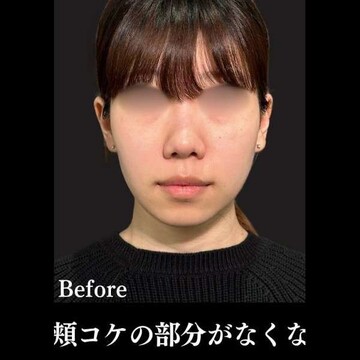 PRISM Beauty Clinicのリフトアップの症例写真[ビフォー]