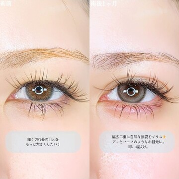 アリエル美容クリニック 大宮院の二重の症例写真