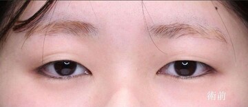 聖心美容クリニックの二重の症例写真[ビフォー]