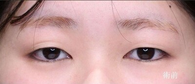 眼瞼下垂手術で自然に目の開きを改善（術後1ヶ月）の症例写真[ビフォー]