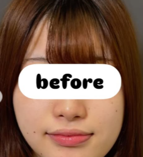Plume Clinicの脂肪吸引の症例写真[ビフォー]