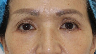 表ハムラ法の症例写真[アフター]