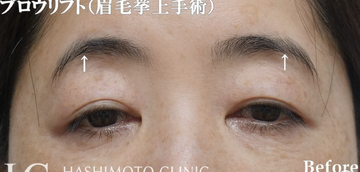 静岡美容外科橋本クリニックの目元・クマ・眉下・涙袋整形の症例写真[ビフォー]
