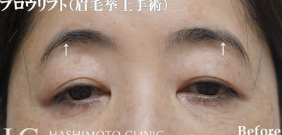 ブロウリフト(眉毛挙上手術)の症例写真[ビフォー]