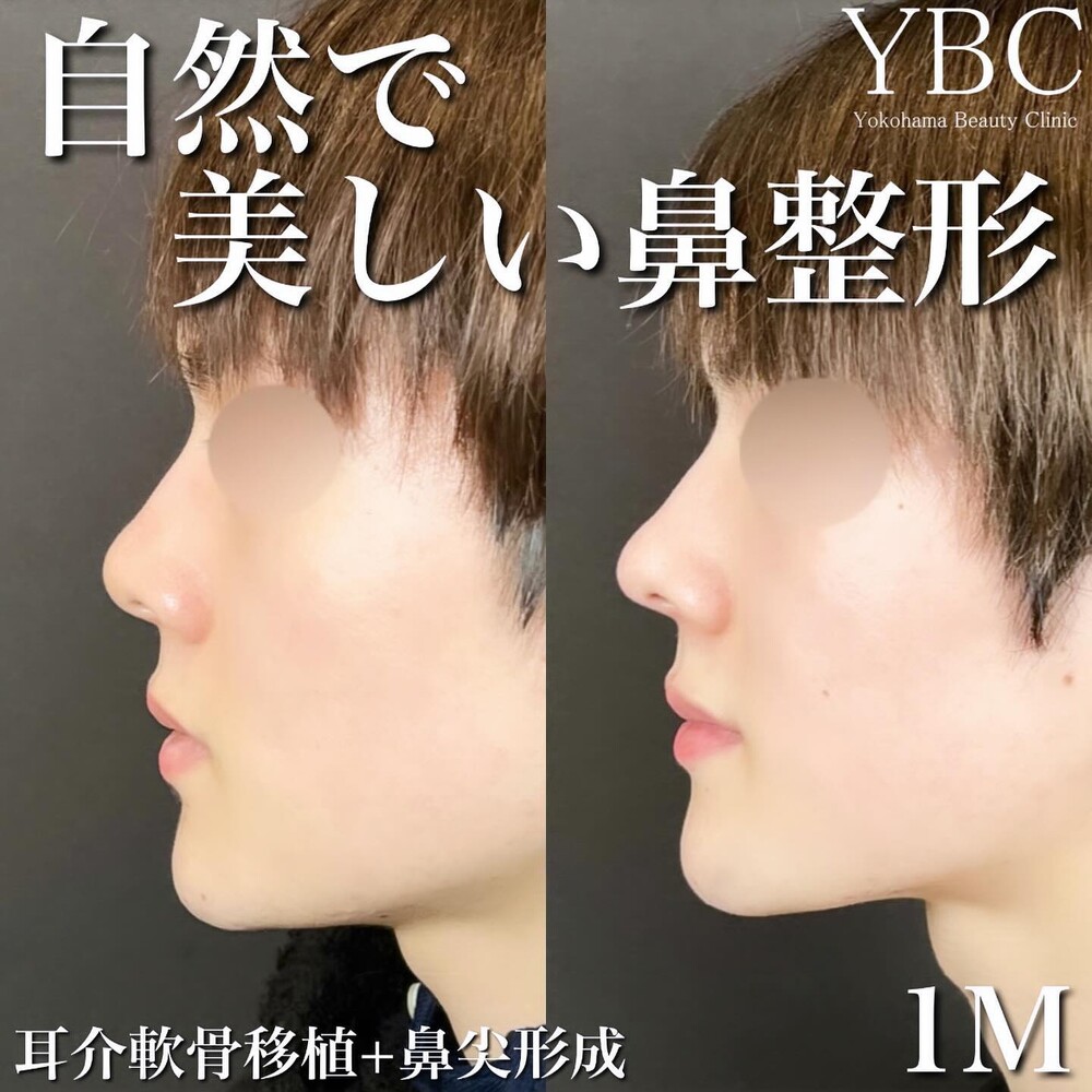 小鼻 あぐら鼻大改善❗️ 鼻先の丸みと小鼻の張り出しがお悩みの患者