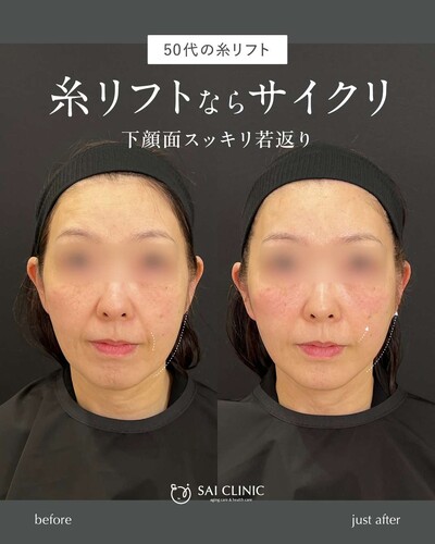 糸リフト（SAI LIFT STANDARD）14本の症例写真