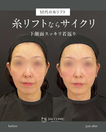 SAI CLINIC （サイクリニック）のリフトアップの症例写真