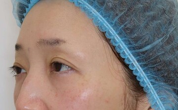 すなおクリニックの目元・クマ・眉下・涙袋整形の症例写真[ビフォー]