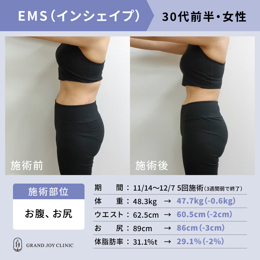 シェイプリフト　定価約30万　美容　痩身　ダイエット 30代 女性] EMS（インシェイプ）（痩身、メディカルダイエット）の症例
